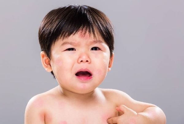 Dấu hiệu nhận biết và cách chăm sóc trẻ bị dị ứng đạm bò