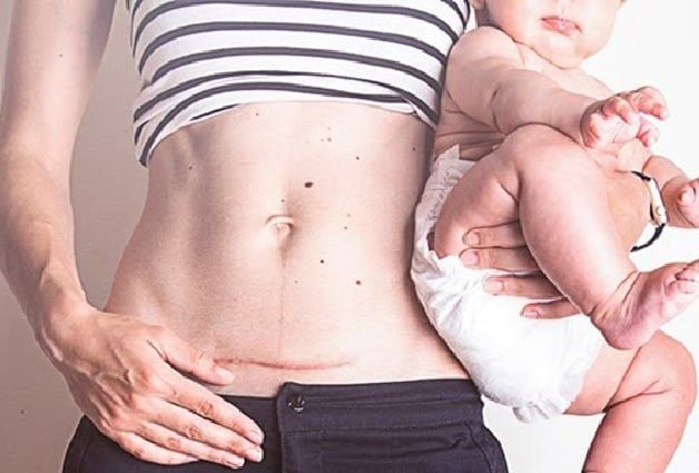 Vết mổ sau sinh bao lâu thì lành? Những mốc mẹ cần biết để an tâm hồi phục