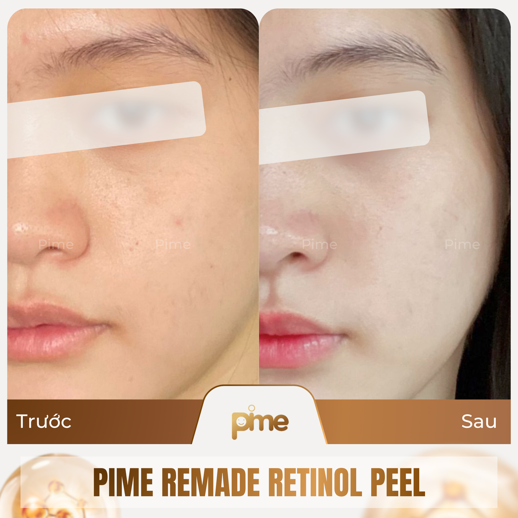 Vì sao Peel Retinol đa tầng là xu hướng trẻ hóa da hiện nay? Cách ứng dụng xu hướng này vào spa thành công!