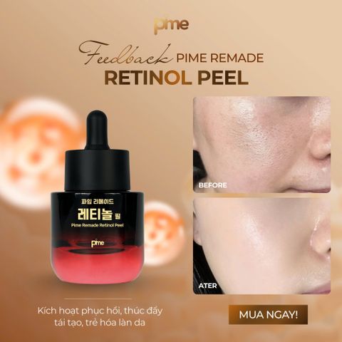 TOP 5 sai lầm thường gặp khi Peel Retinol khiến da yếu, kích ứng kéo dài