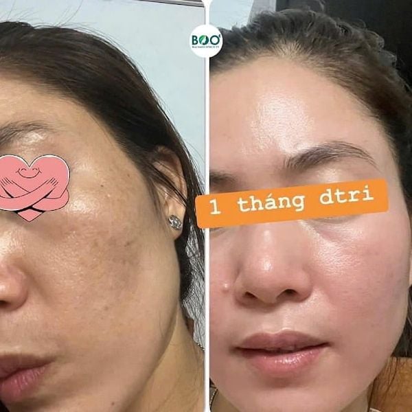 Hiệu quả rõ ràng của  Bộ Điều Trị Nám Chuyên Sâu Aithan Melasma And Whitening Set