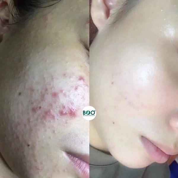 Công dụng vượt trội Kem hỗ trợ trị mụn ASSOS Tretinoin 0.05% Krem