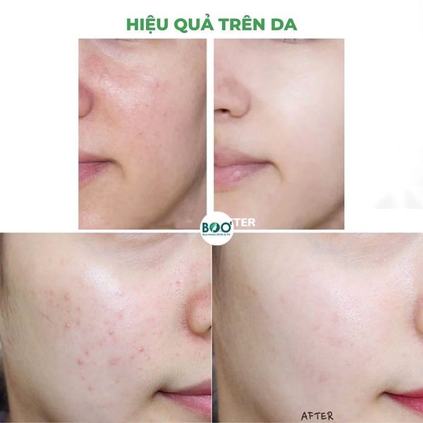 Hiệu quả rõ ràng của Kem dưỡng giảm bóng nhờn, ngừa mụn Farmona Dermacos Anti-Acne Matting Cream 50ml