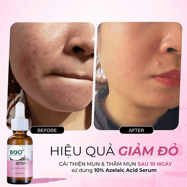 Tổng quan về tinh chất giảm mụn Synergy Therm Azelaic Acid 10%