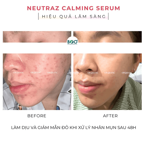 Tổng quan về tinh chất làm dịu da Orobanc Newtraz Calming Serum