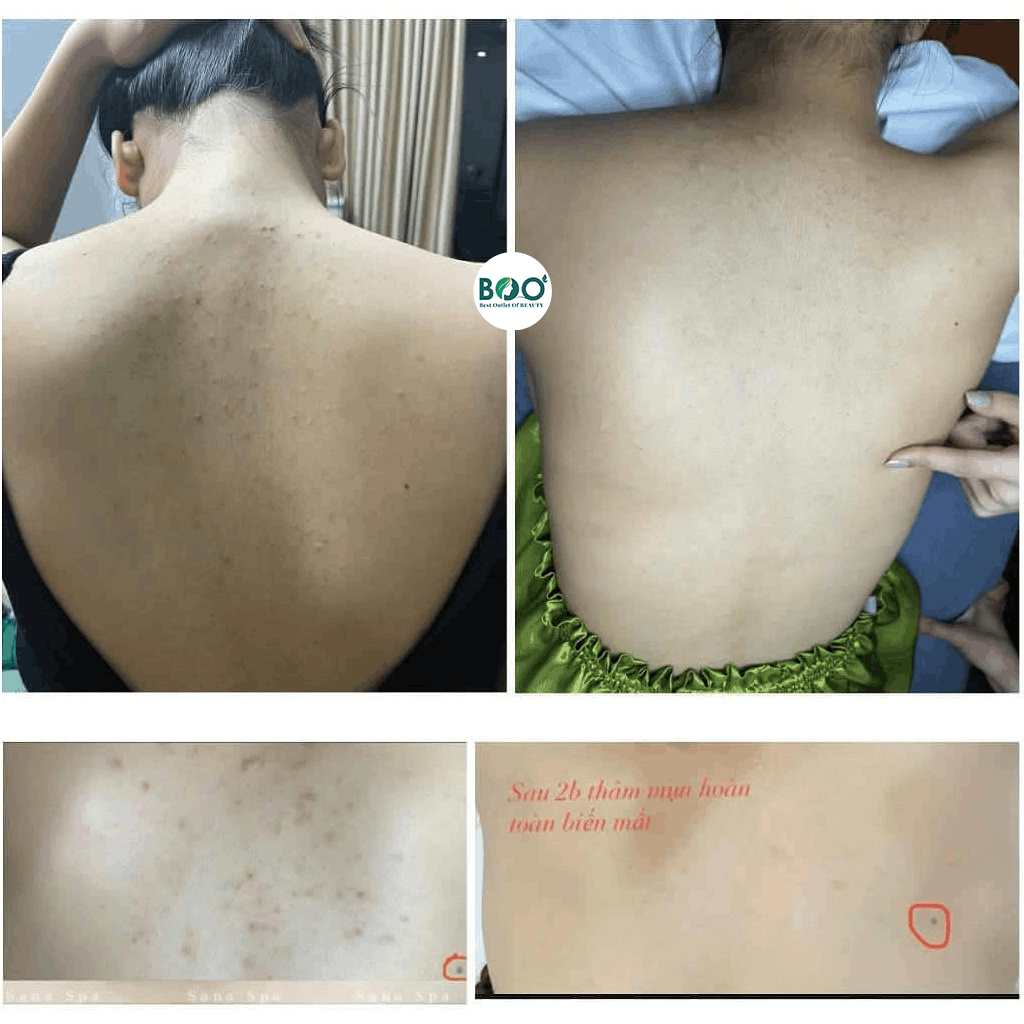 Tình trạng mụn cơ thể lý tưởng sử dụng Xịt mụn lưng ICON SKIN