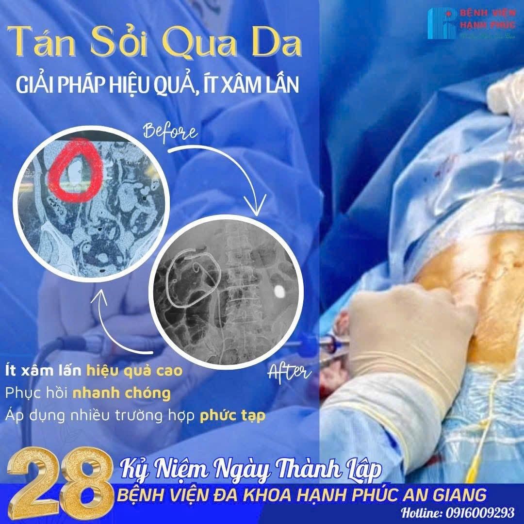 TÁN SỎI QUA DA – GIẢI PHÁP HIỆU QUẢ, ÍT XÂM LẤN TẠI BỆNH VIỆN ĐA KHOA HẠNH PHÚC - AN GIANG