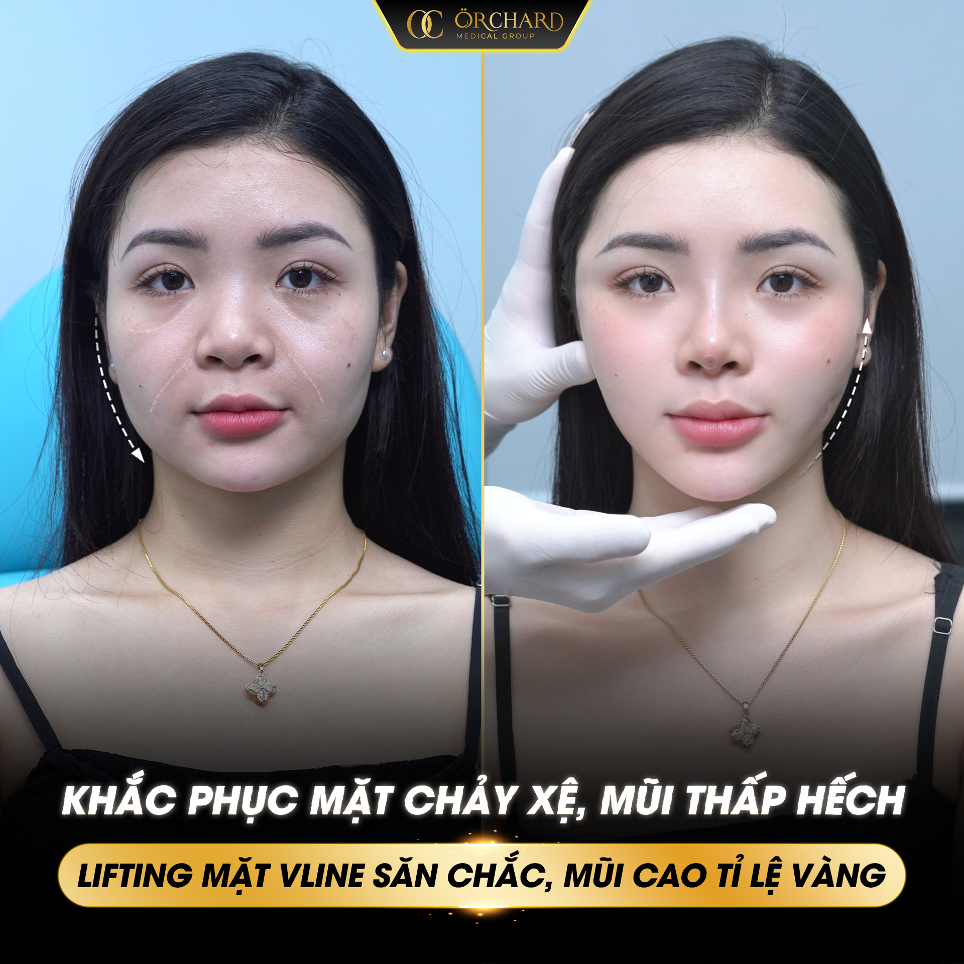 CÁC DÒNG CHỈ NÂNG CƠ ORCHARD ĐANG SỬ DỤNG