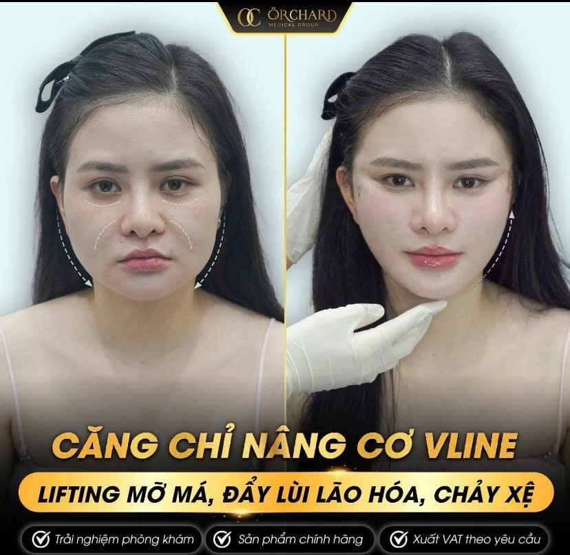 Căng chỉ sẽ cải thiện gương mặt của bạn như thế nào?