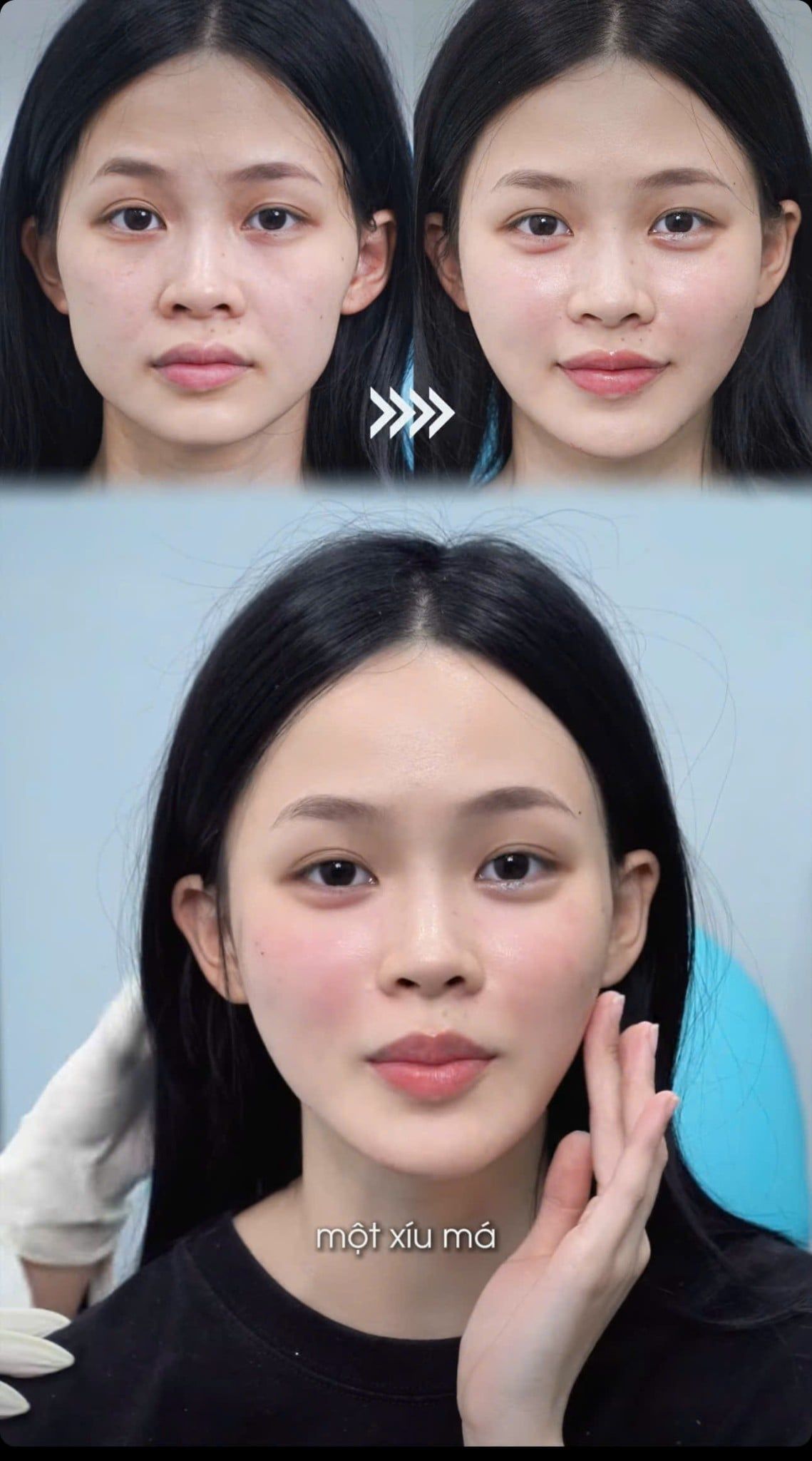 Má baby hot trend - tiêm filler có hiệu quả không?