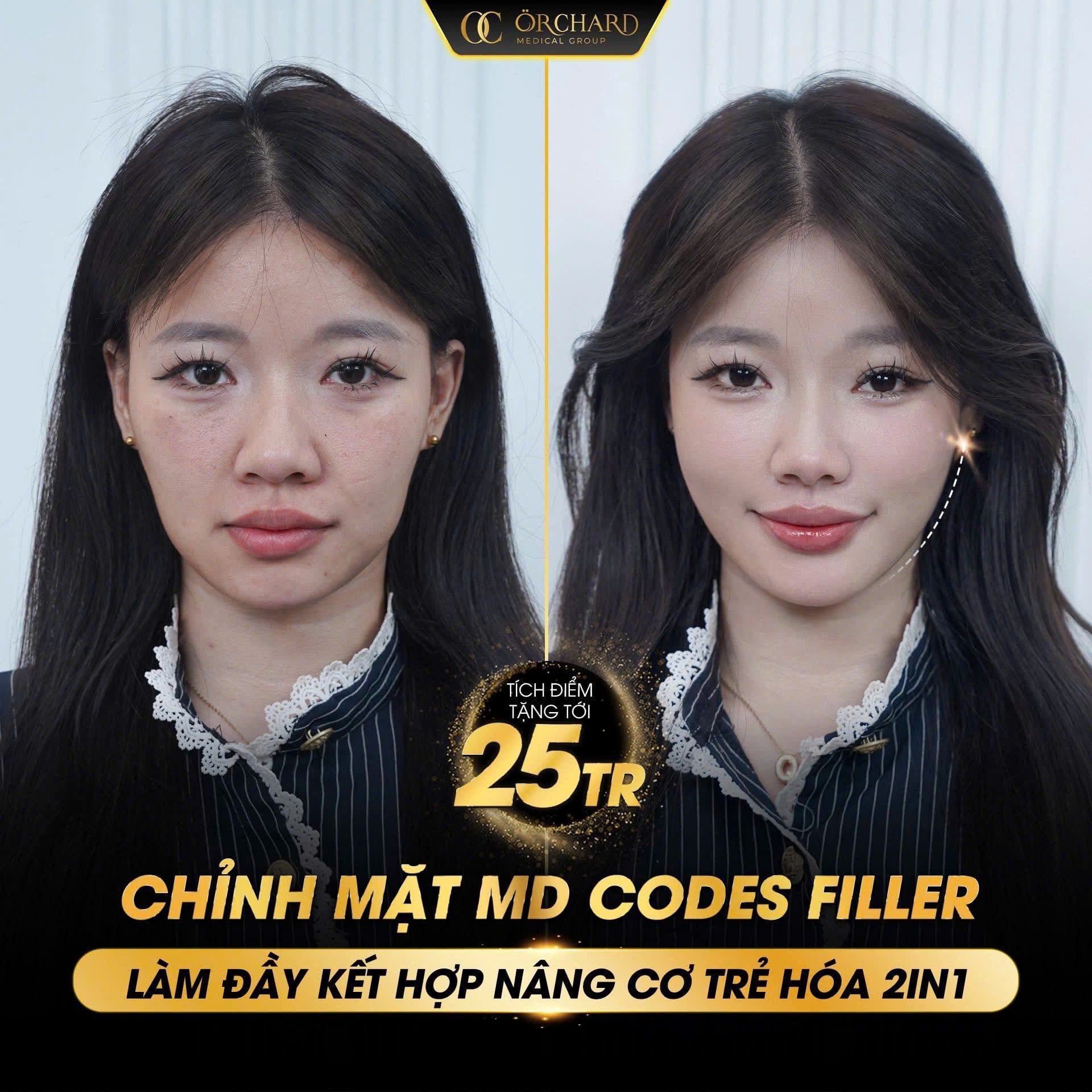 Chỉnh mặt bằng Filler MD CODES - giải pháp trẻ hoá 2in1: làm đầy và nâng cơ toàn diện