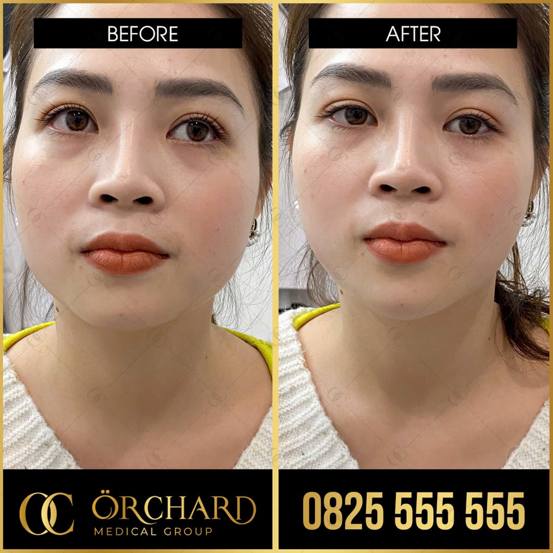 Filler cằm - tạo điểm nhấn hài hoà cho gương mặt