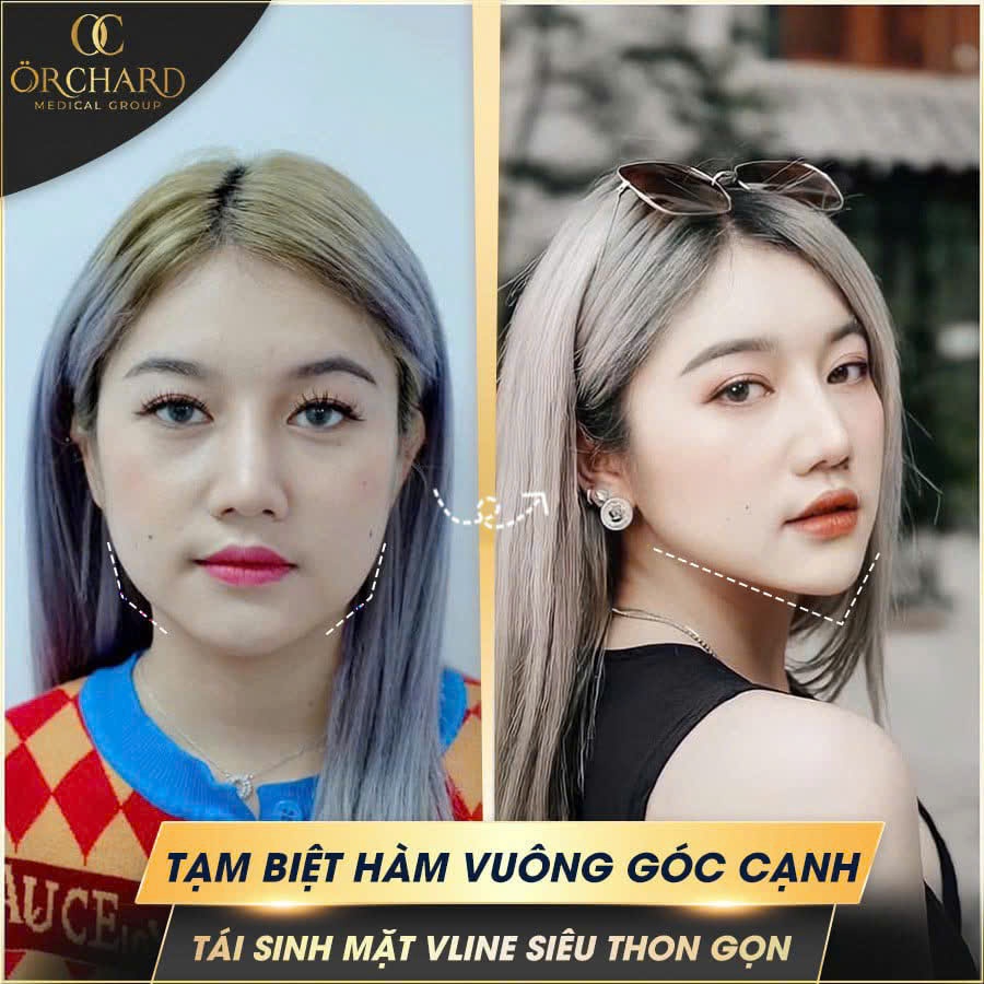 Cơ cắn to khiến khuôn mặt bạnh, thiếu đường nét nữ tính