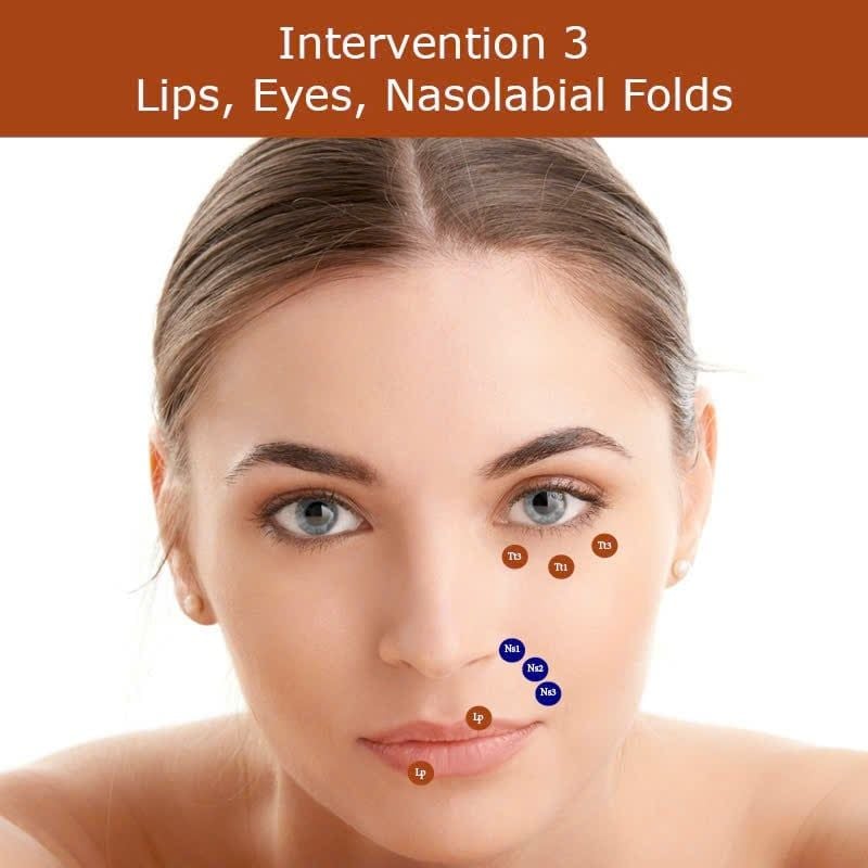 MD CODES - bản đồ tiêm filler an toàn và chuẩn y khoa