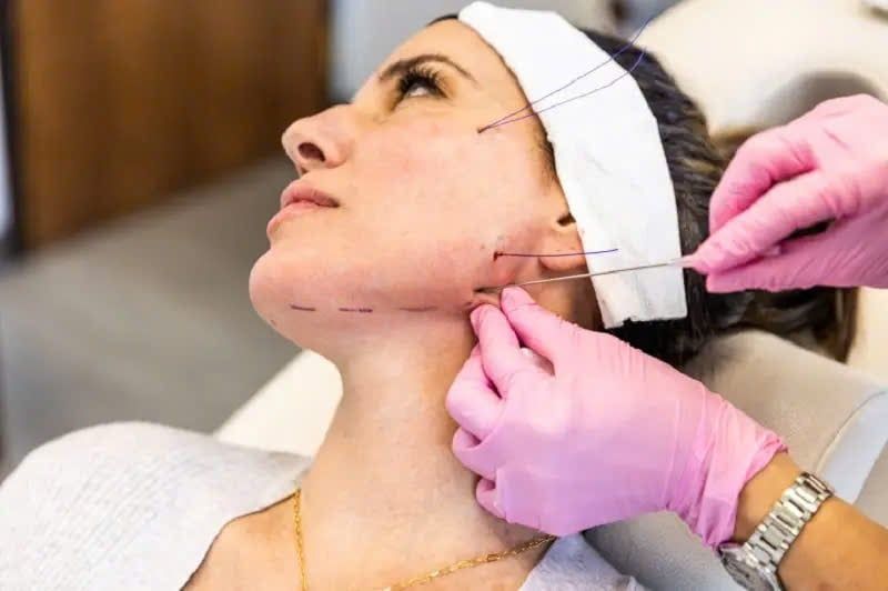 Nâng cơ viền hàm- lựa chọn hiệu quả cho vùng da chảy xệ