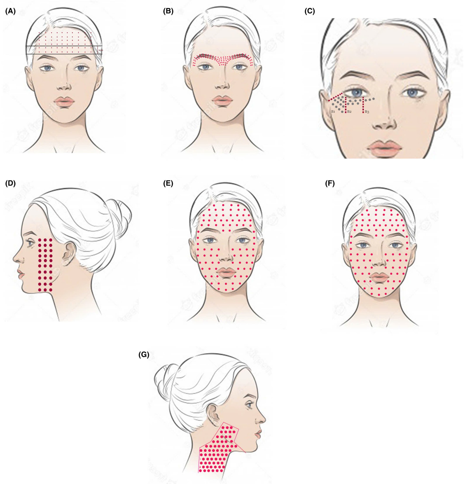 Meso Botox - giải pháp kiềm dầu và thu nhỏ lễ chân lông tối ưu