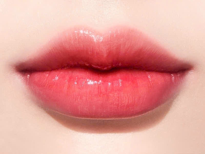 Filler khoé môi cười - Nụ cười tự nhiên, cuốn hút không gượng gạo