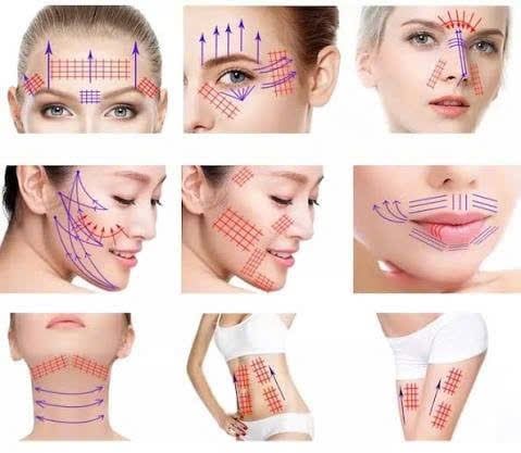 Cấy chỉ mono - trẻ hoá da từ lớp chân bì, không cần nghỉ dưỡng