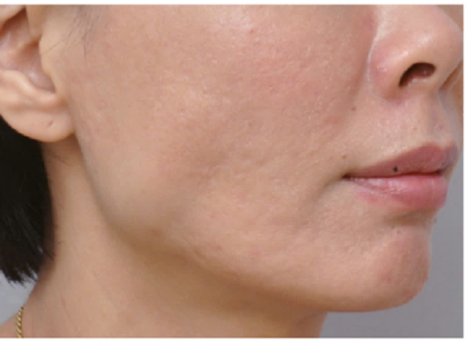 Biến chứng phình cơ cắn khi nhai sau tiêm Botulinum toxin