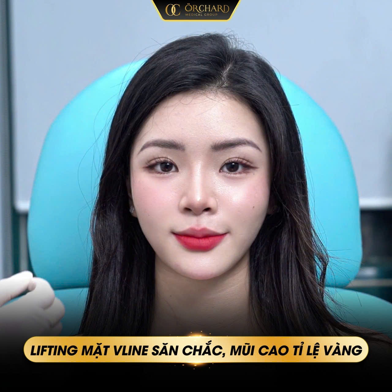 Những ai có thể thực hiện phương pháp nâng mũi bằng chỉ?