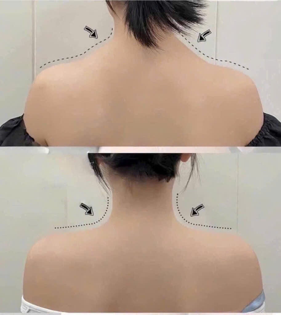 Thon gọn vai và bắp tay bằng Botulinum Toxin