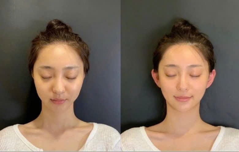 Tiêm Filler Tai Vểnh – Bí Quyết Cho Gương Mặt Cân Đối Và Dễ Thương Hơn