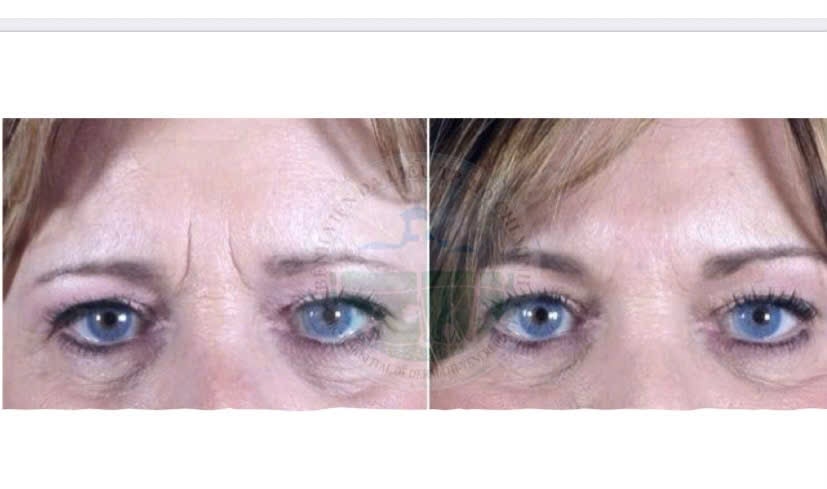 Tiêm filler vùng gian mày ( Glabellar filler injection)