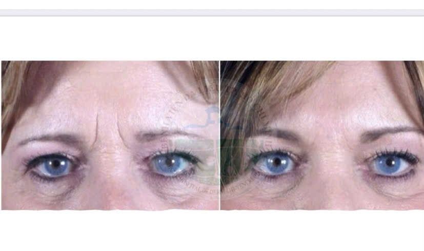 Tiêm filler vùng gian mày ( Glabellar filler injection)