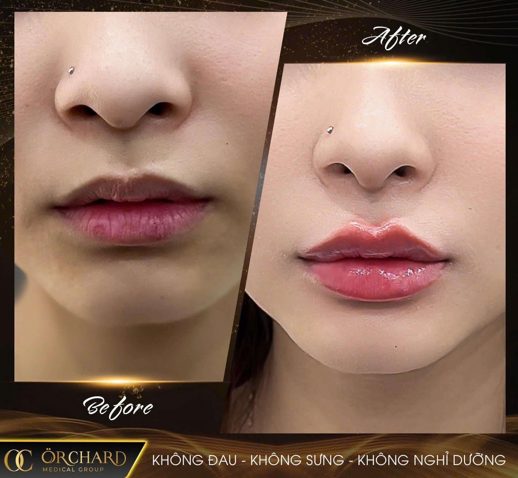 Tiêm Filler môi – lựa chọn hàng đầu cho làn môi căng mọng tự nhiên