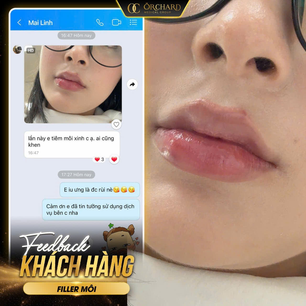 Feedback khách hàng khi tiêm filler môi tại Orchard