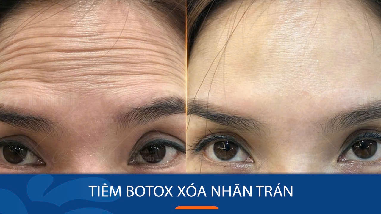 Tiêm Botox xoá nhăn trán - giải pháp hiệu quả cho làn da mượt mịn