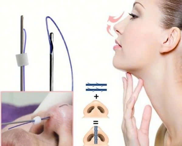 Mũi chỉ - giải pháp nâng mũi ít xâm lấn
