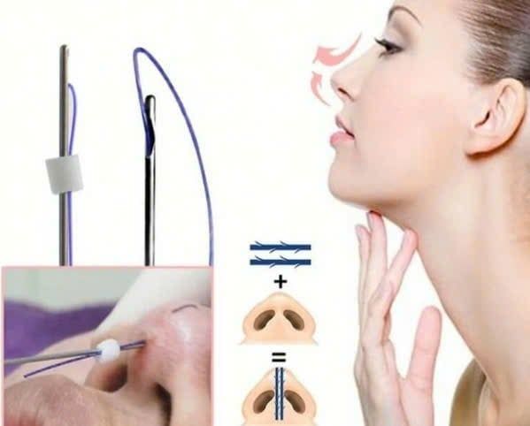 Mũi chỉ - giải pháp nâng mũi ít xâm lấn