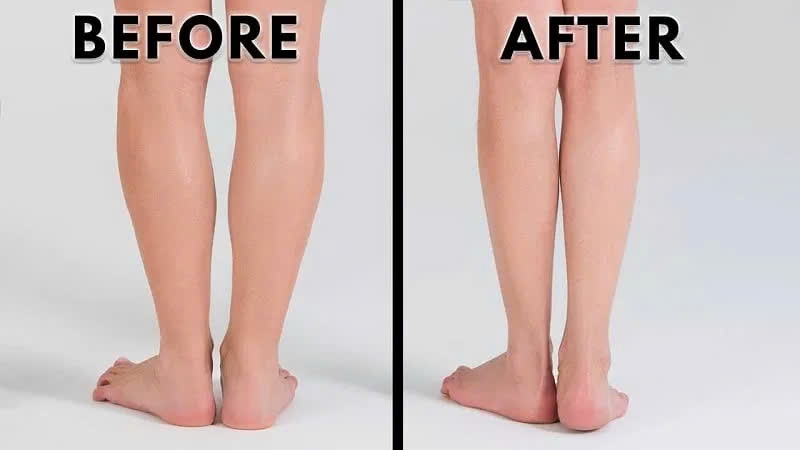 Tiêm Botulinum toxin làm thon gọn bắp chân