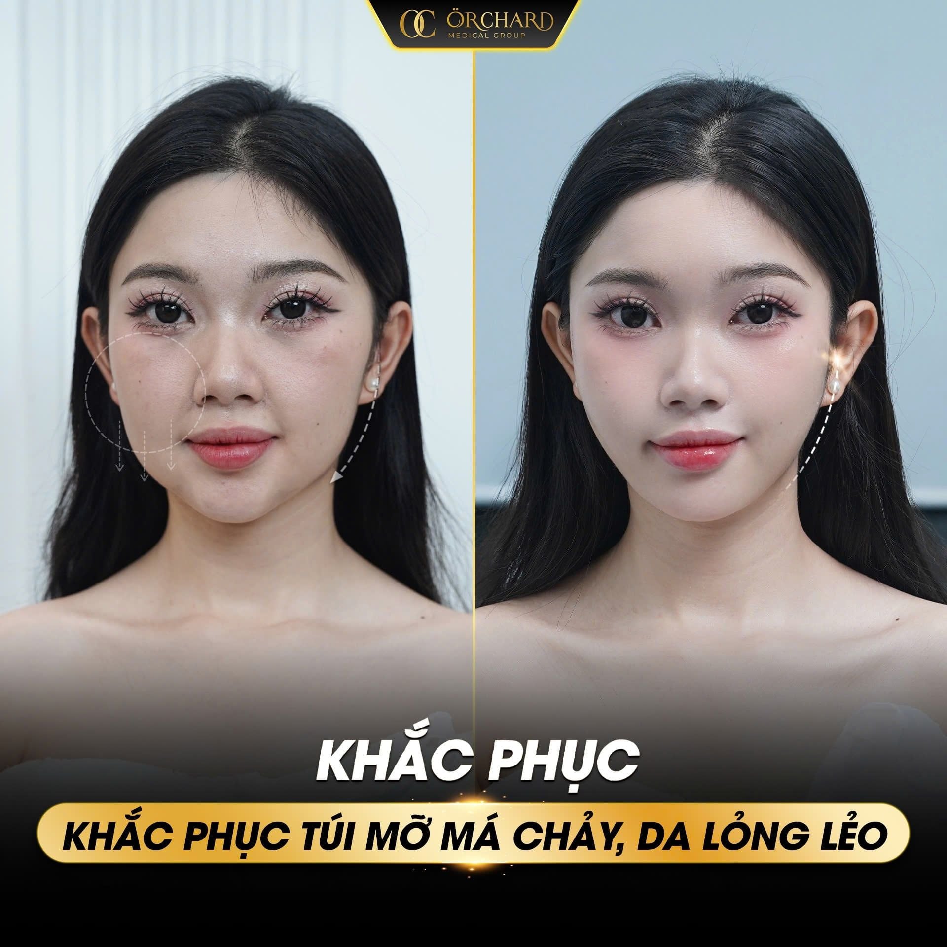 Tiêm tan mỡ như thế nào hiệu quả?