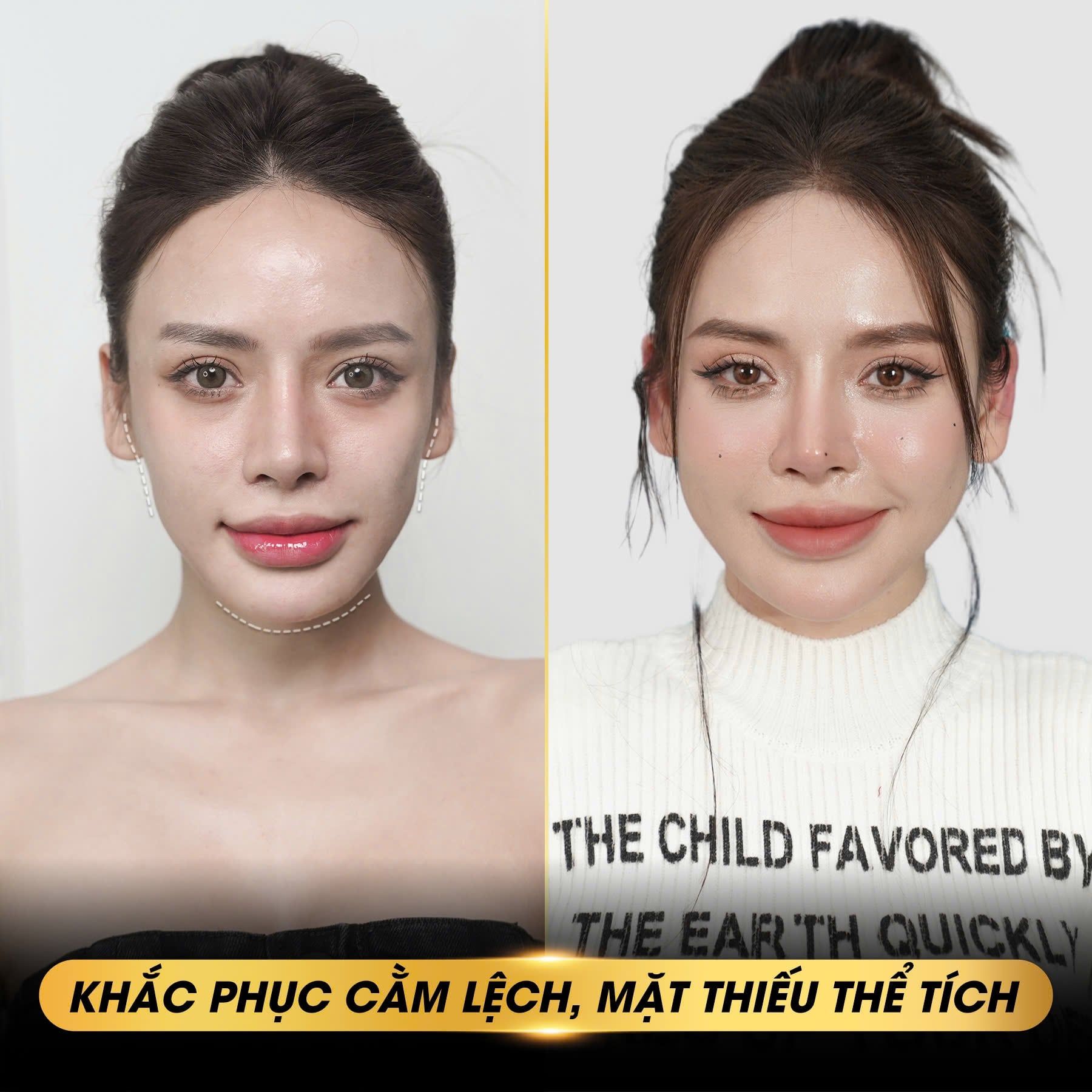 Tiêm Filler Cân Chỉnh Gương Mặt – Đẹp Hài Hòa, Tự Nhiên Không Dao Kéo