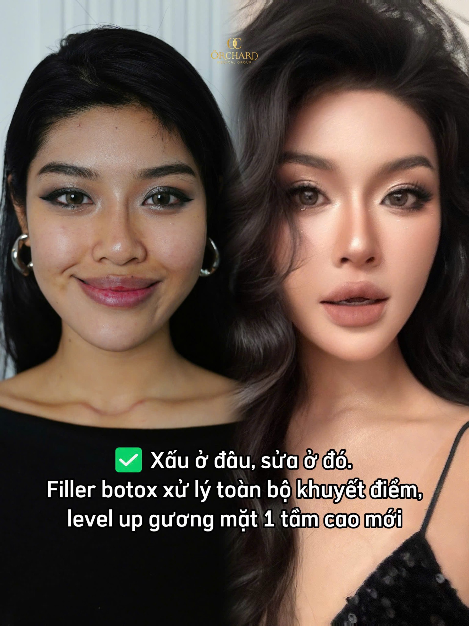 Bạn muốn cải thiện khuôn mặt vuông thế nào?