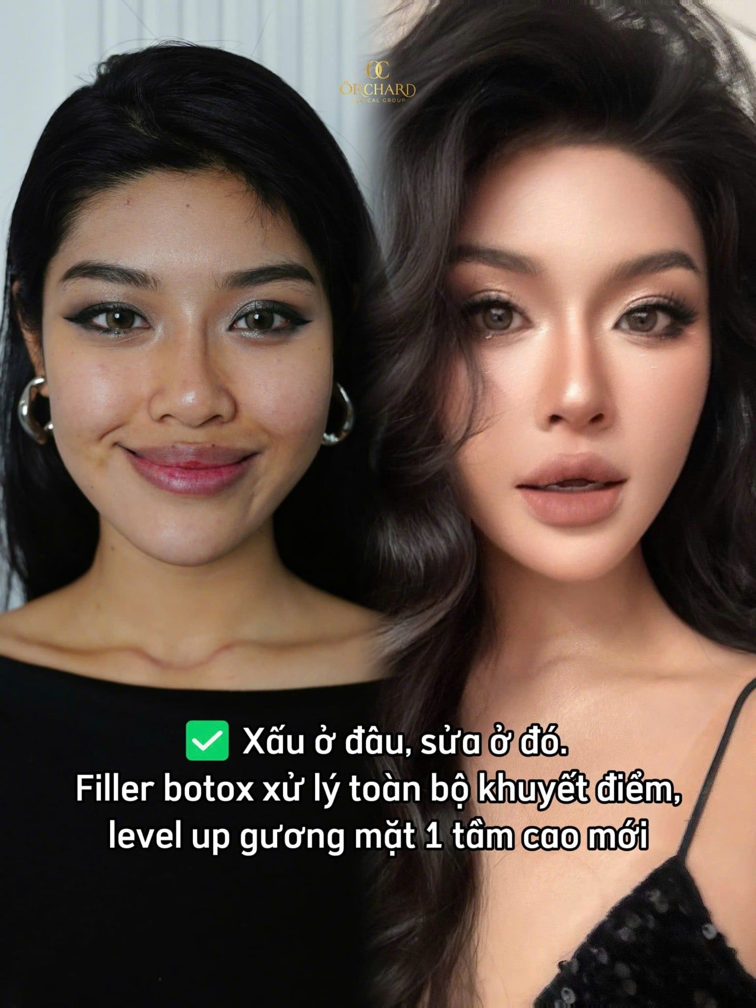 Bạn muốn cải thiện khuôn mặt vuông thế nào?