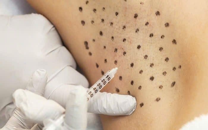 Cách giảm tăng tiết mồ hôi nách hiệu quả