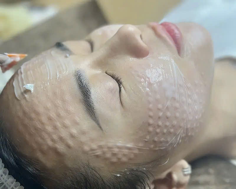 Phương pháp tiêm Mesotherapy trong trẻ hoá da