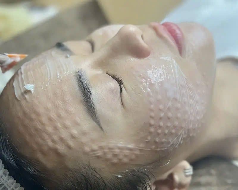 Phương pháp tiêm Mesotherapy trong trẻ hoá da