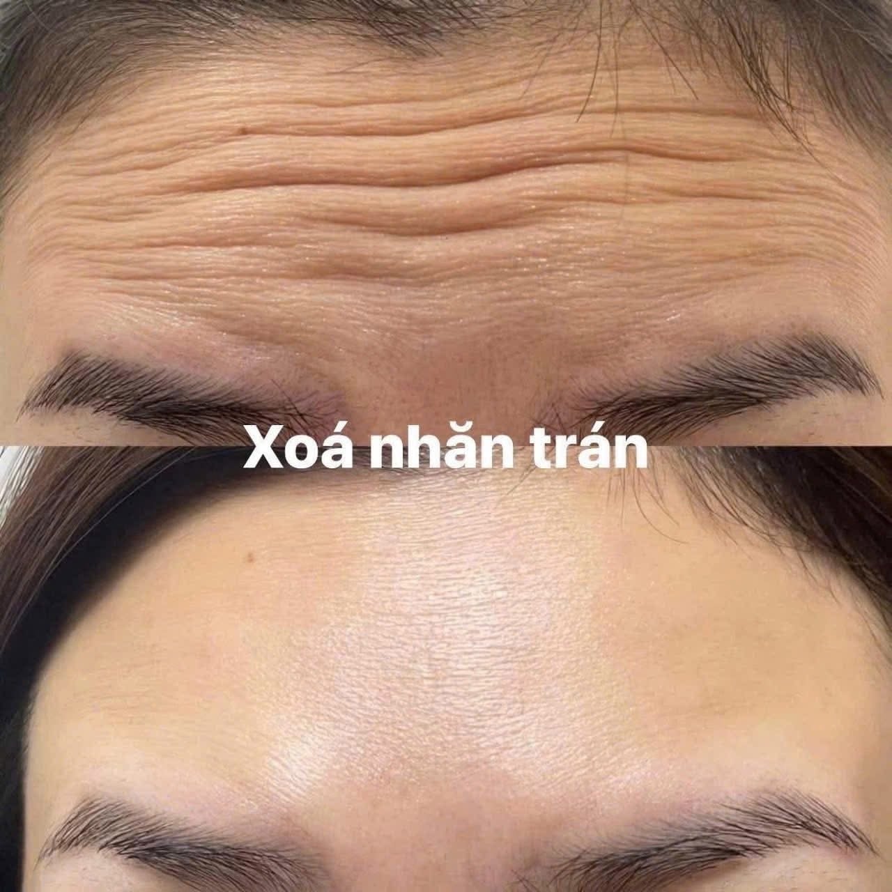 Chăm sóc sau tiêm Botox như nào hiệu quả?