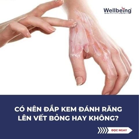 Có nên đắp kem đánh răng lên vết bỏng hay không?