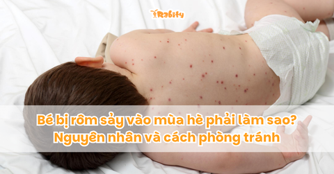 Bé bị rôm sảy vào mùa hè phải làm sao? Nguyên nhân và cách phòng tránh