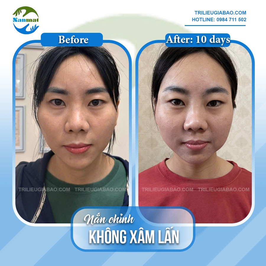 NẮN MẶT LỆCH KHÔNG XÂM LẤN: MS.THÚY SAU 10 BUỔI NẮN CHỈNH