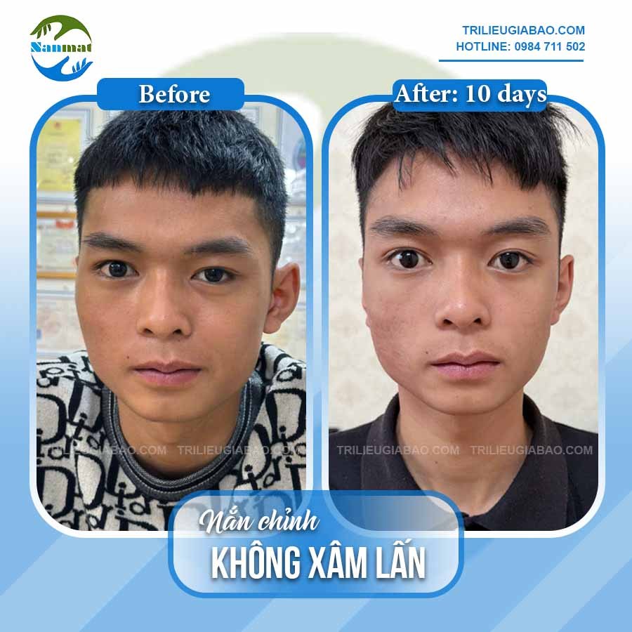 NẮN MẶT LỆCH KHÔNG XÂM LẤN: MR.PHƯƠNG SAU 10 BUỔI NẮN CHỈNH