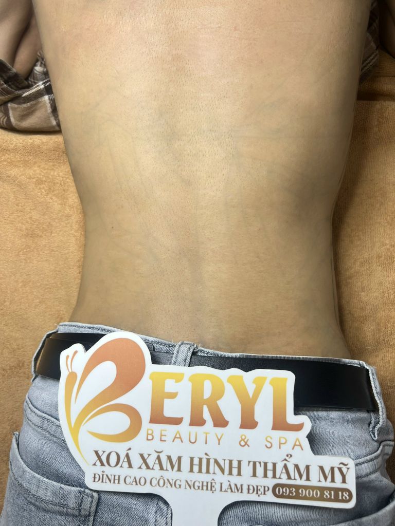 Hình ảnh sau khi xóa xăm