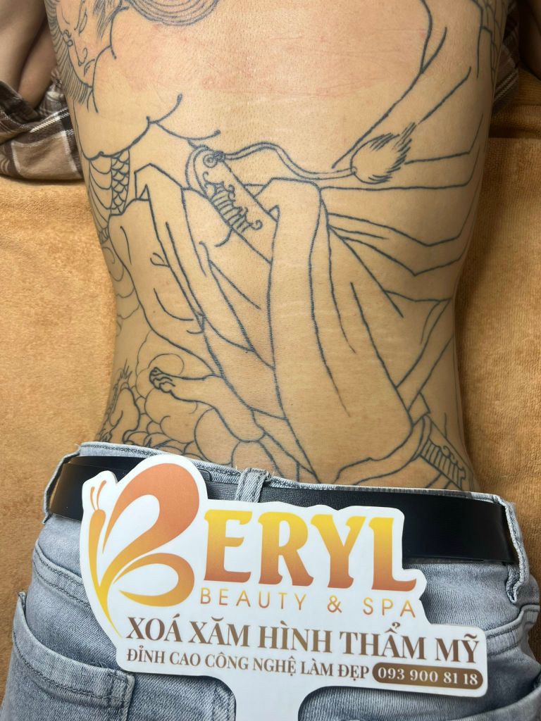 Hình ảnh trước khi xóa hình xăm