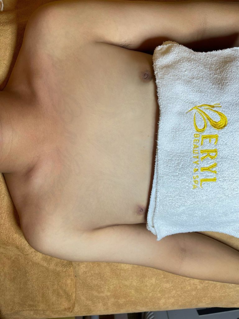 Hình ảnh sau khi xóa xăm