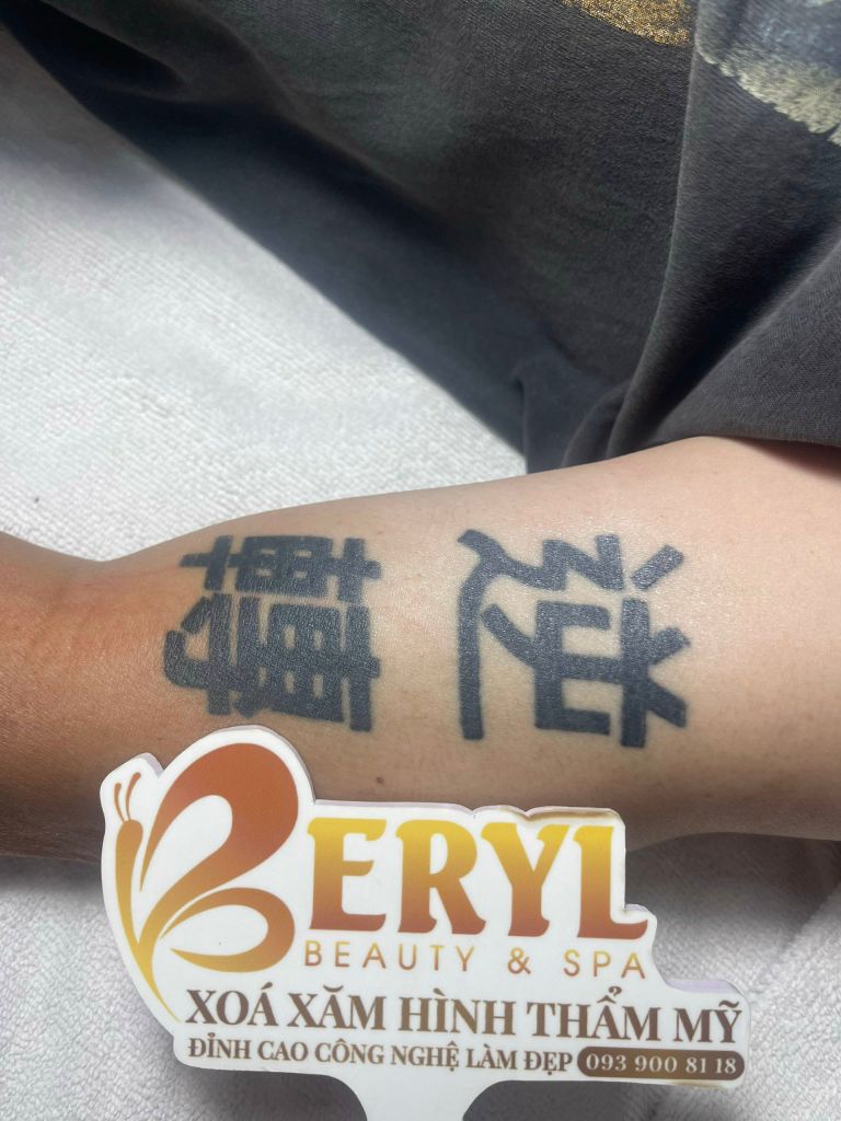 Hình ảnh trước khi xóa xăm